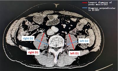 Sarcopenia and Systemic Inflammation Response Index Predict Response to Systemic Therapy for Hepatocellular Carcinoma and Are Associated With Immune Cells